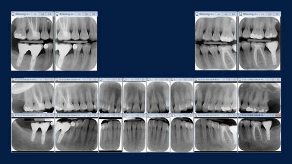radiologia dentale digitale