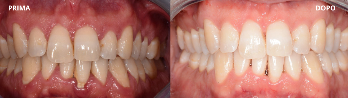 PRIMA E DOPO (frontale) paradontite, si può guarire?