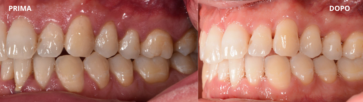 PRIMA E DOPO (lato sx) paradontite, si può guarire?