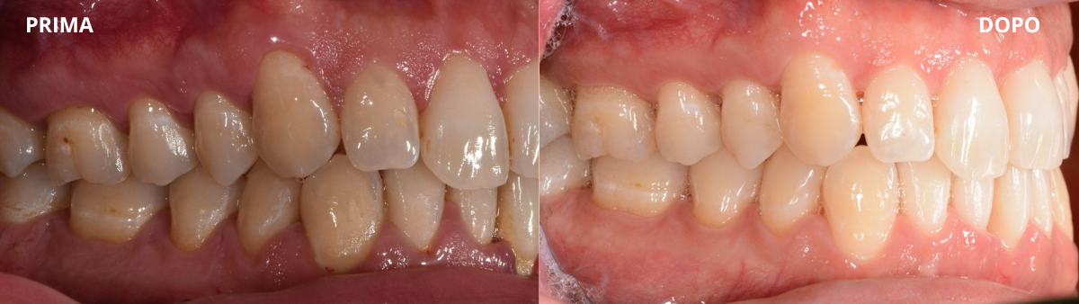 PRIMA E DOPOO (lato dx) paradontite, si può guarire?
