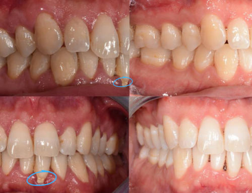 Guarire dalla Parodontite è possibile?