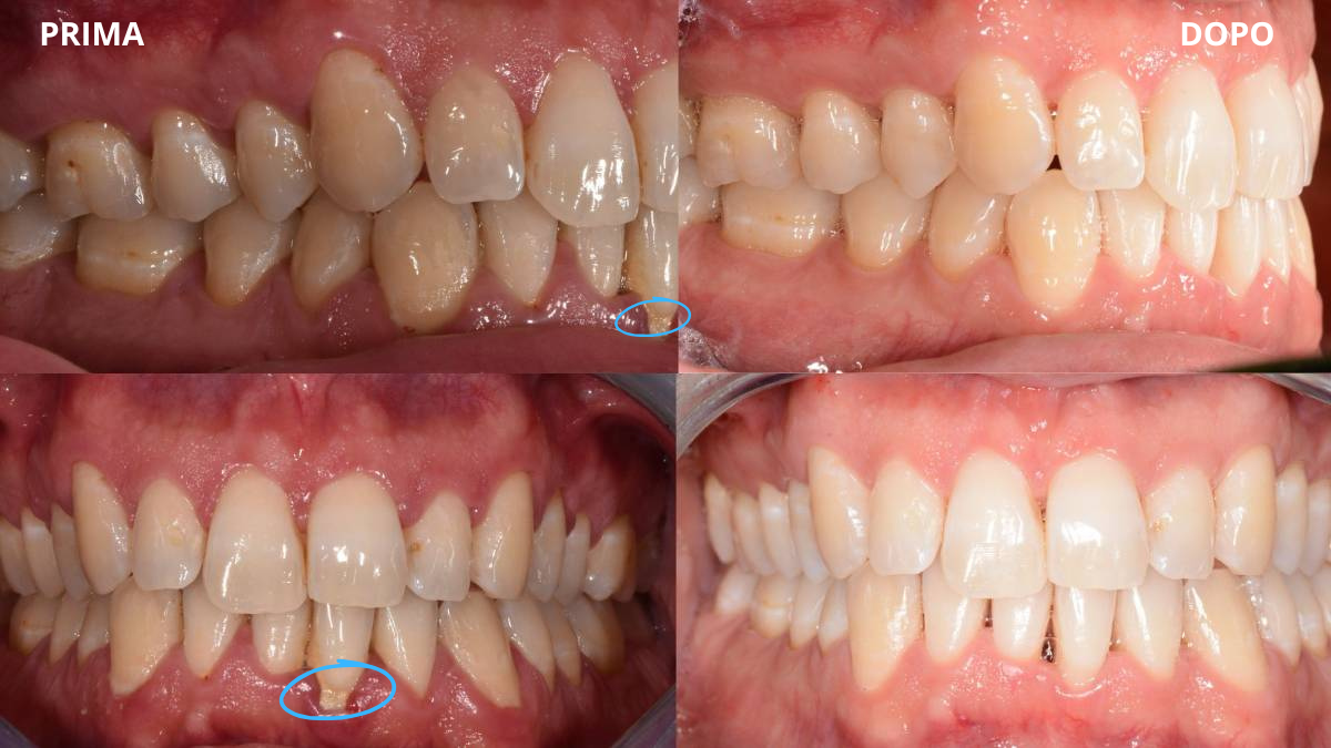 copertina paradontite paradontite, si può guarire?